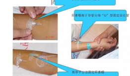 留置针操作视频,轻松掌握静脉穿刺技巧